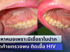 คนไข้แทบช็อก! ไปหาหมอเพราะมีเชื้อราในปาก สุดท้ายตรวจพบ ติดเชื้อ HIV ทั้งที่ไม่มีอะไรกับใครมาแล้ว 3 ปี