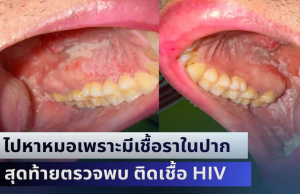 คนไข้แทบช็อก! ไปหาหมอเพราะมีเชื้อราในปาก สุดท้ายตรวจพบ ติดเชื้อ HIV ทั้งที่ไม่มีอะไรกับใครมาแล้ว 3 ปี